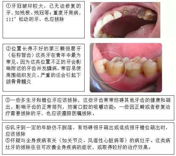 拔牙